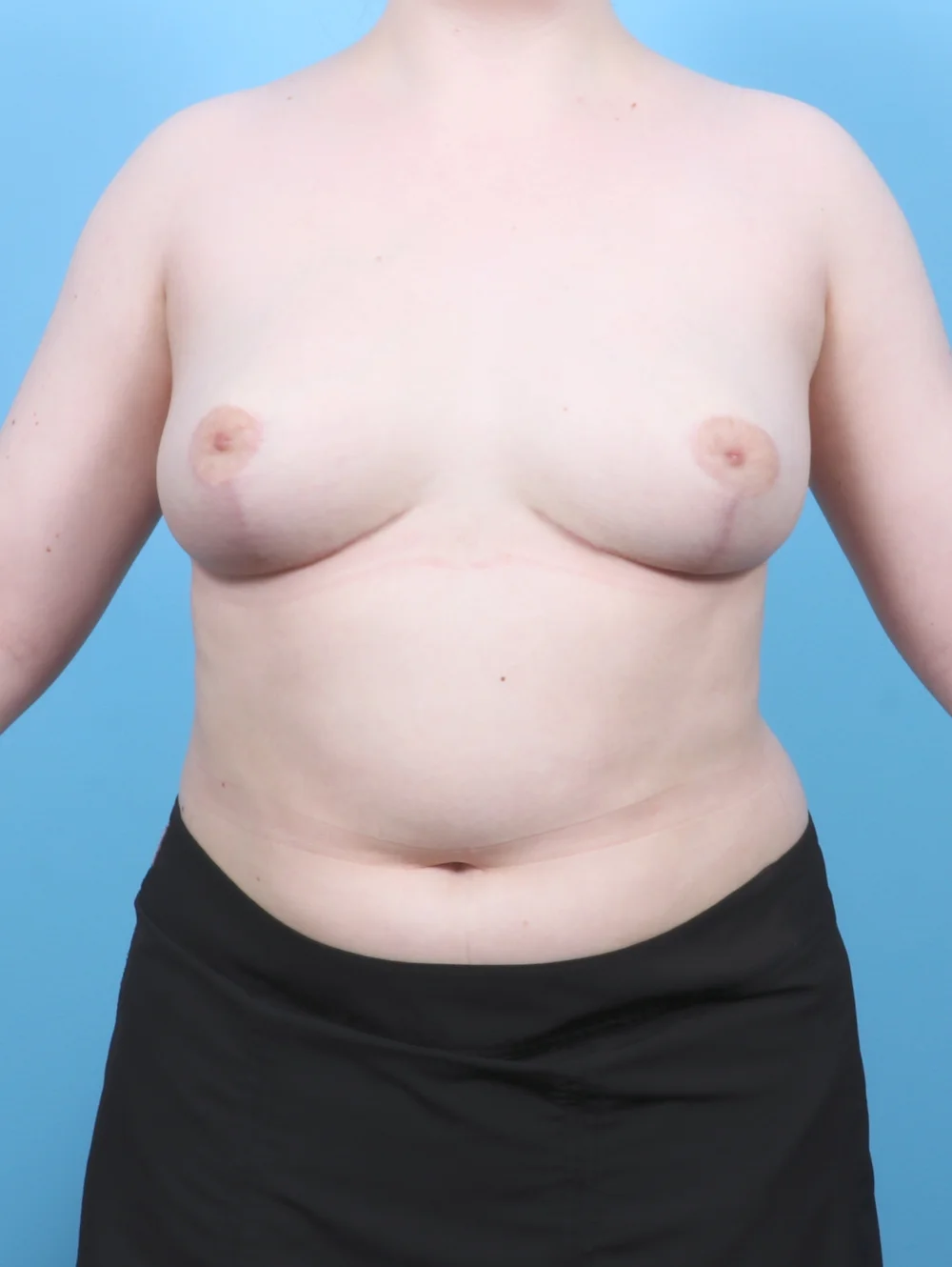 AE-BREASTREDUCTION-26YRS-FRONT-AFTER-EDITED