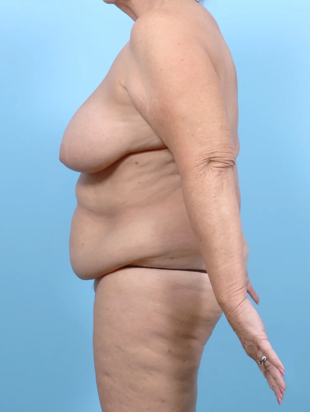 CS-BODYLIFT-MASTOPEXY-68YRS-SIDE-BEFORE-EDITED