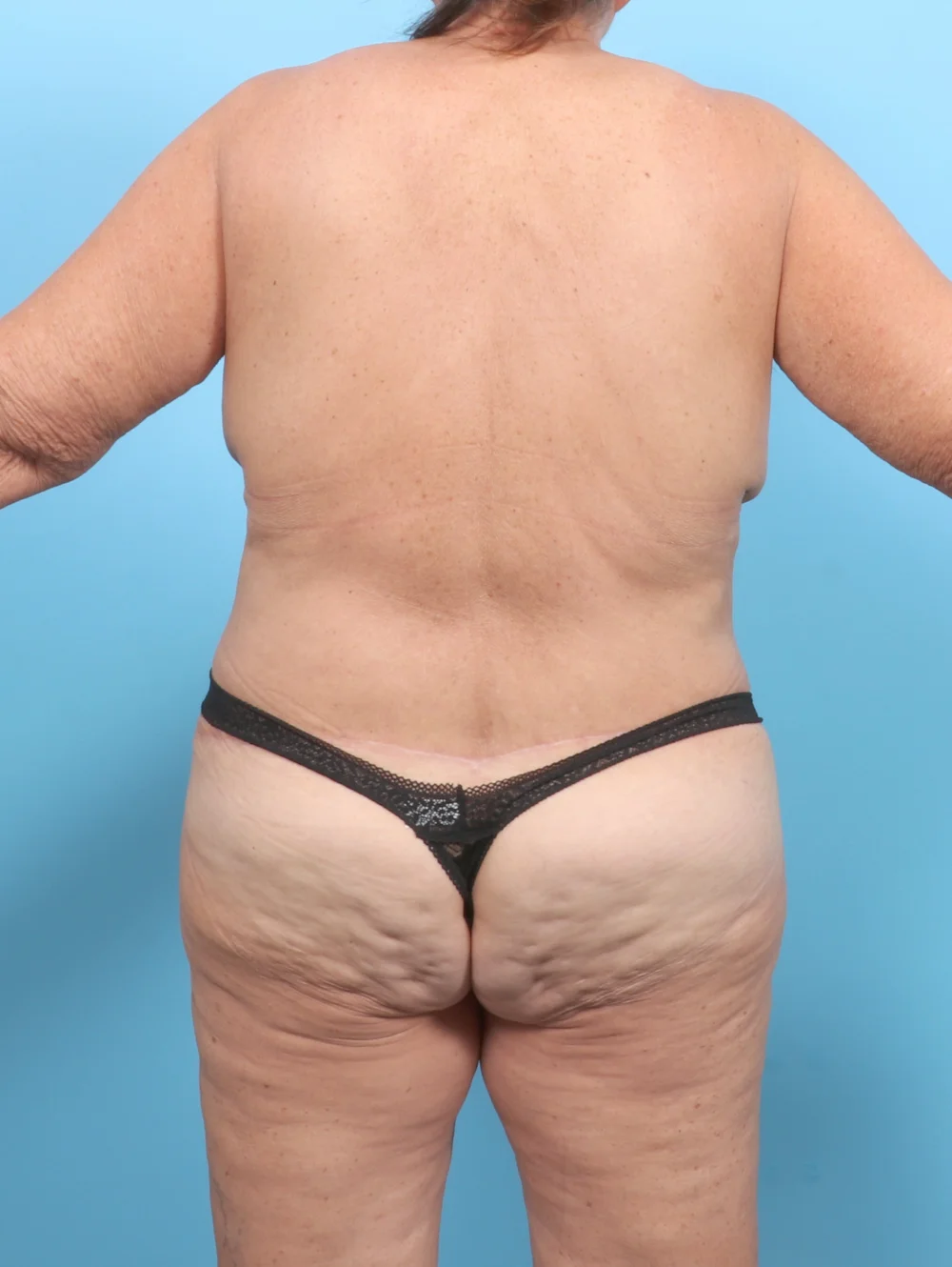 Copy of Copy of CS-BODYLIFT-MASTOPEXY-68YRS-BACK-AFTER-EDITED