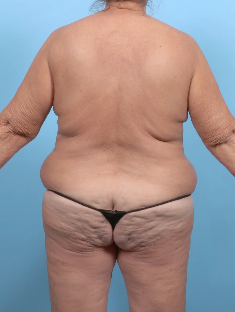 Copy of Copy of CS-BODYLIFT-MASTOPEXY-68YRS-BACK-BEFORE-EDITED