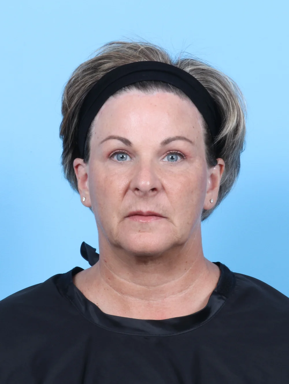 HH-56YRS-BROWLIFT-UPPERBLEPH-FRONT-AFTER-EDITED