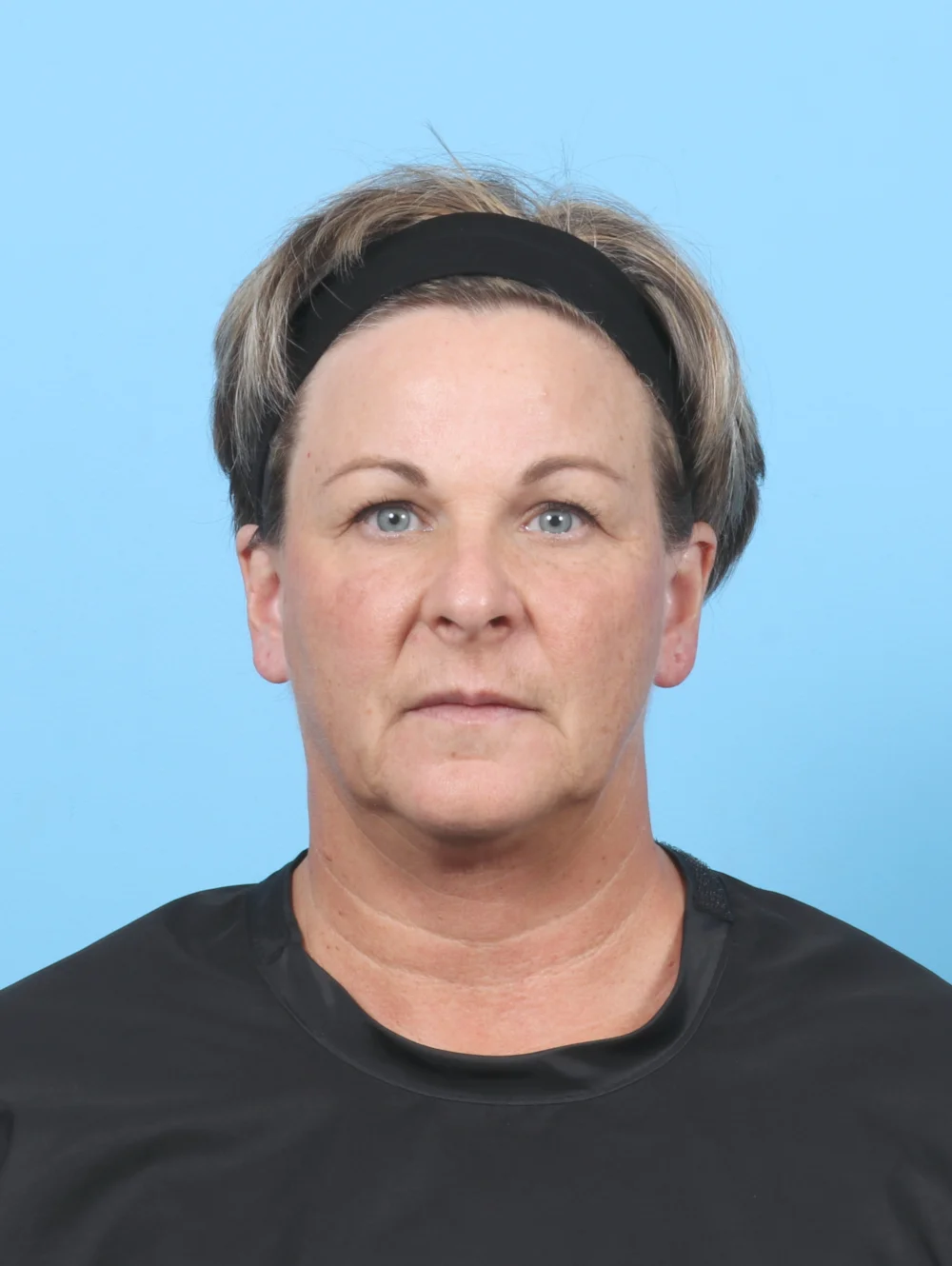 HH-56YRS-BROWLIFT-UPPERBLEPH-FRONT-BEFORE-EDITED