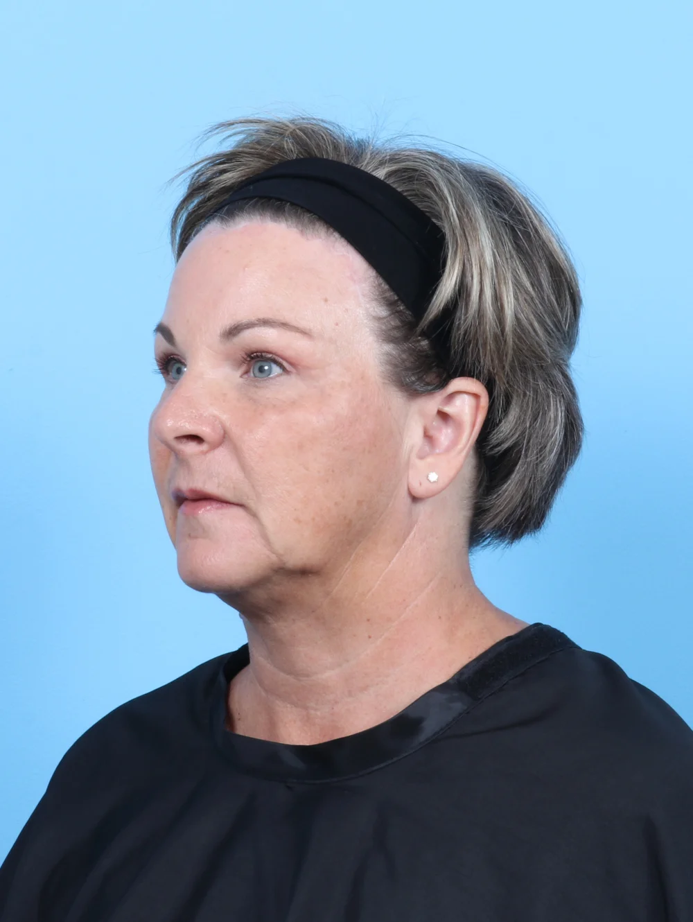 HH-56YRS-BROWLIFT-UPPERBLEPH-OBL-AFTER-EDITED
