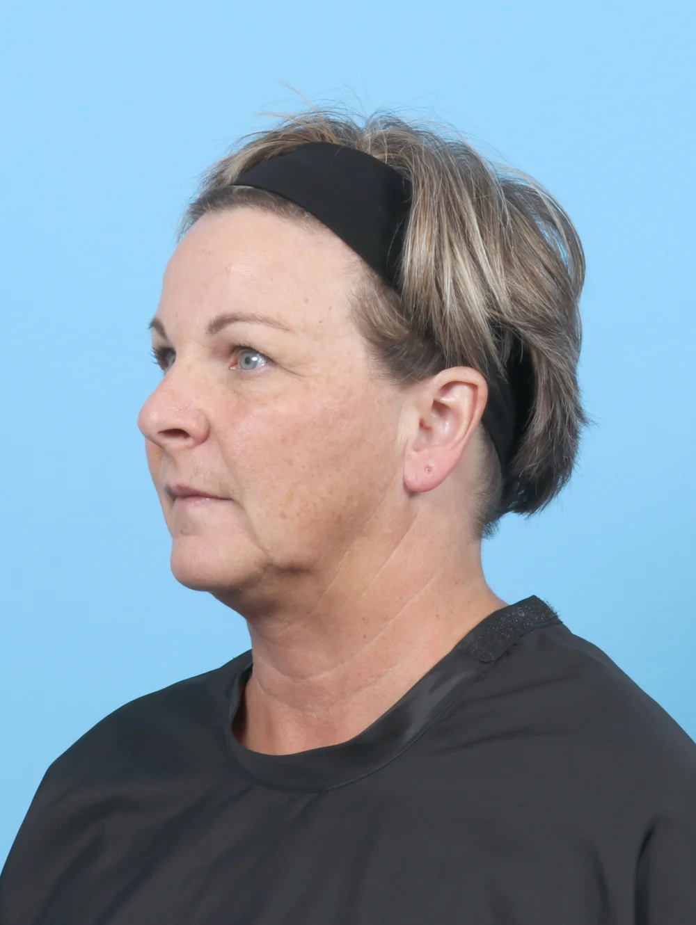 HH-56YRS-BROWLIFT-UPPERBLEPH-OBL-BEFORE-EDITED