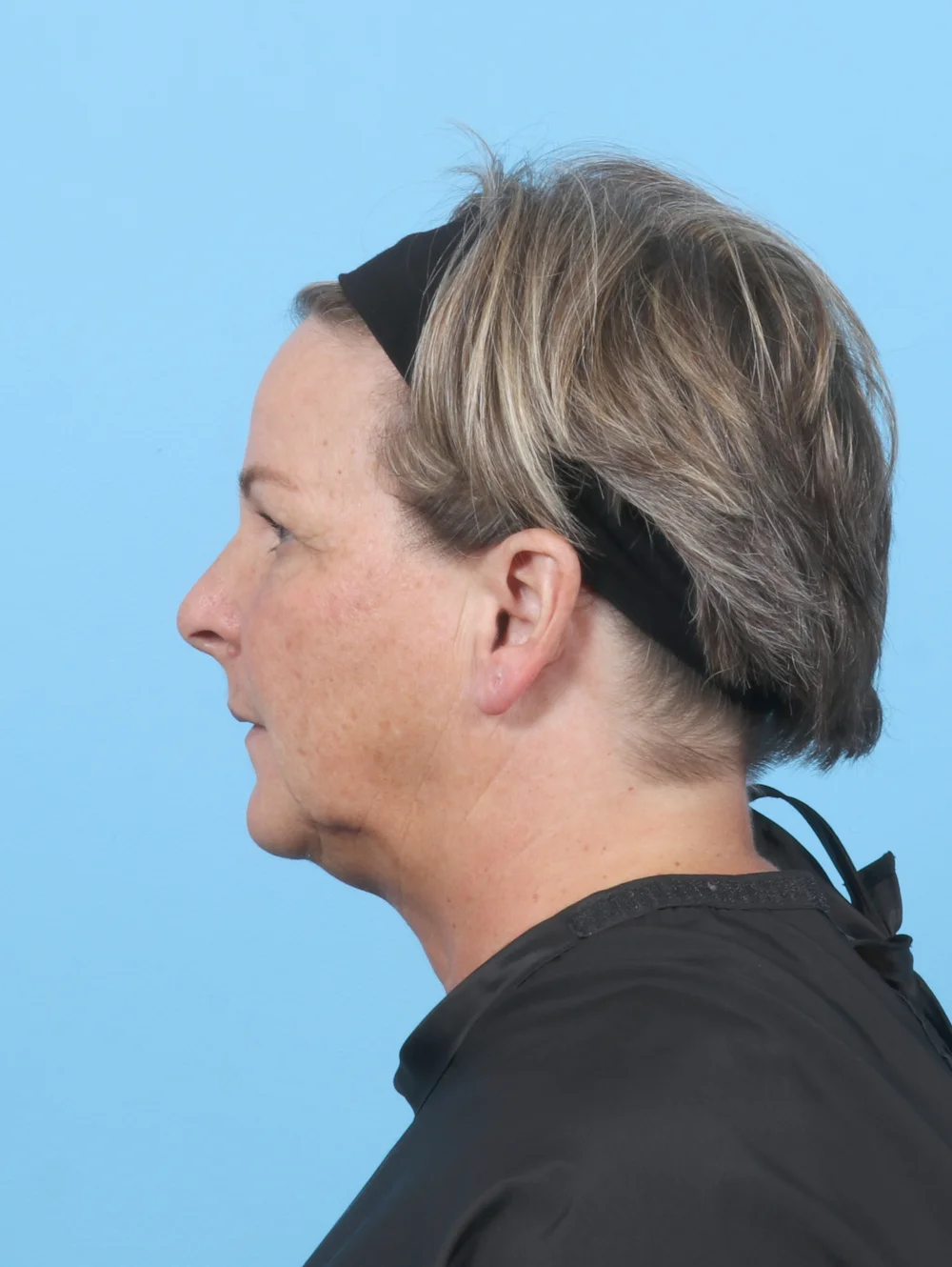 HH-56YRS-BROWLIFT-UPPERBLEPH-SIDE-BEFORE-EDITED