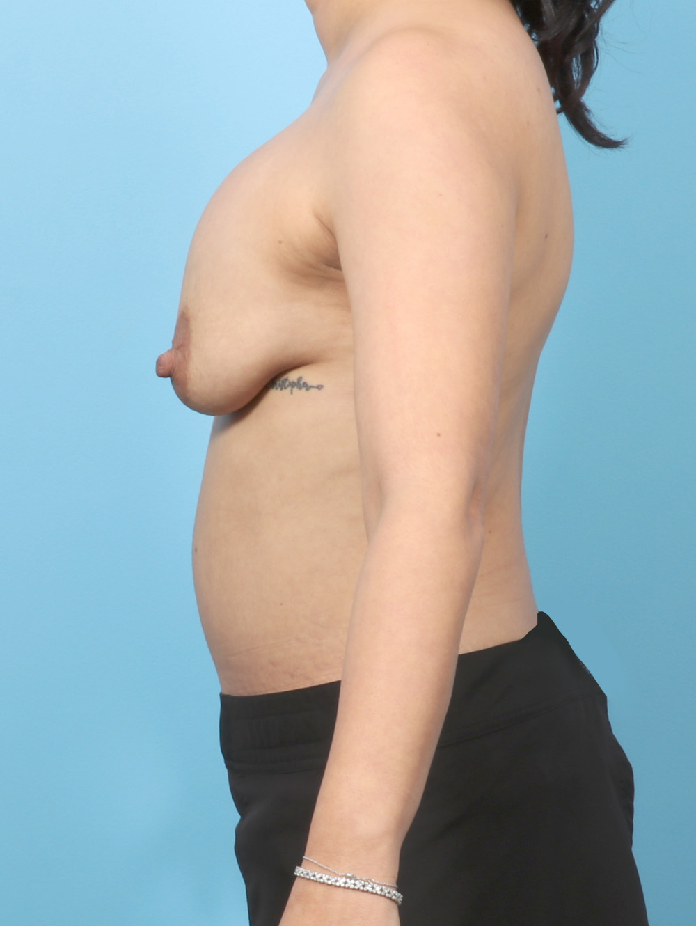 JS-MASTOCAPSREMOVAL-42YRS-SIDE-BEFORE-edited