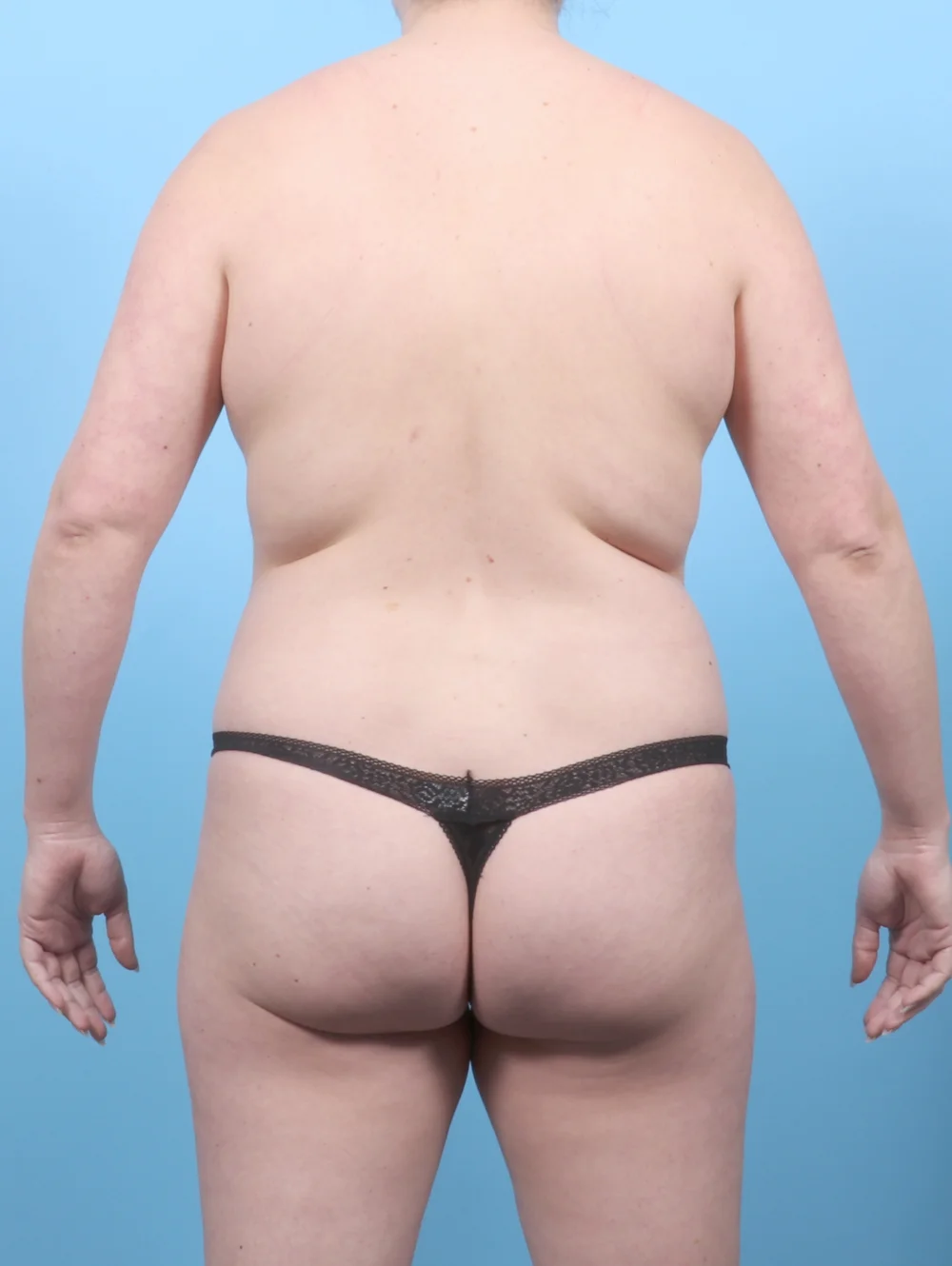 KS-LIPO-31YRS-BACK-BEFORE-edited