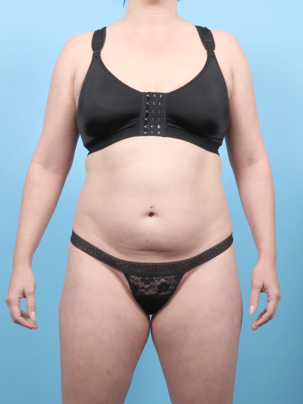 KS-LIPO-31YRS-FRONT-BEFORE-edited