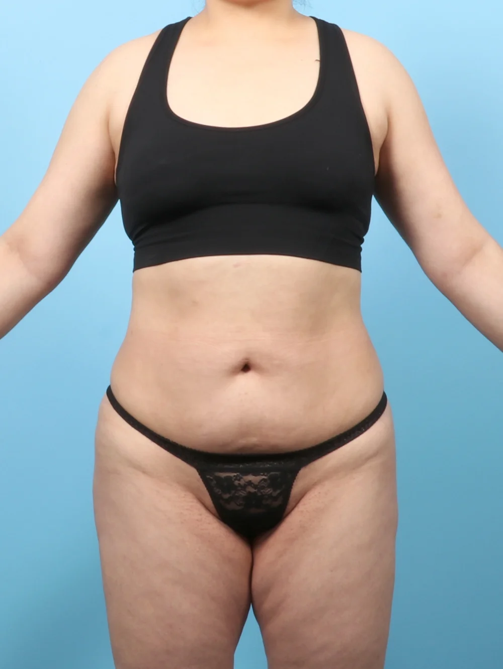 KV-LIPO-BODY-33YRS-FRONT-AFTER-edited