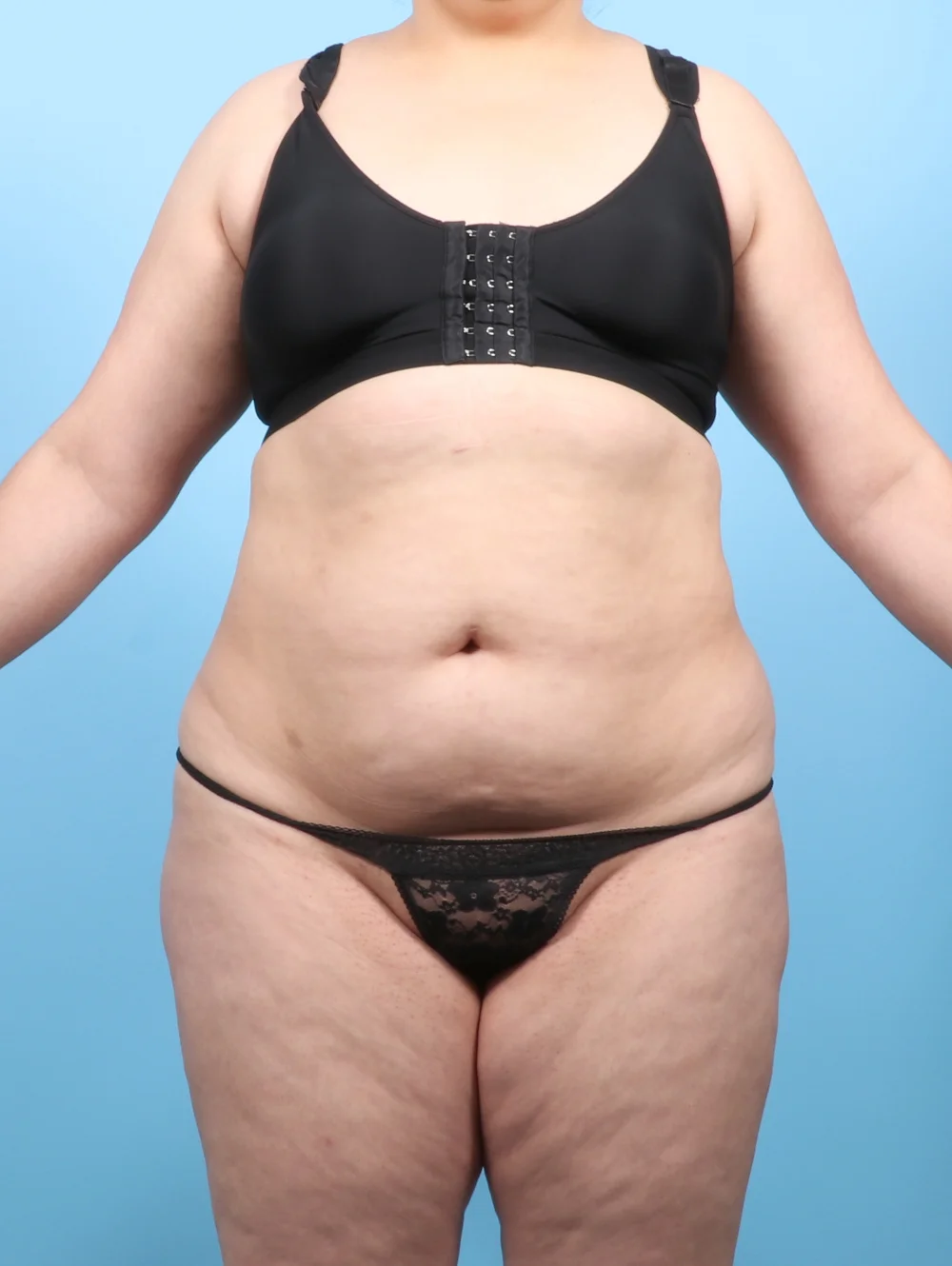 KV-LIPO-BODY-33YRS-FRONT-BEFORE-edited