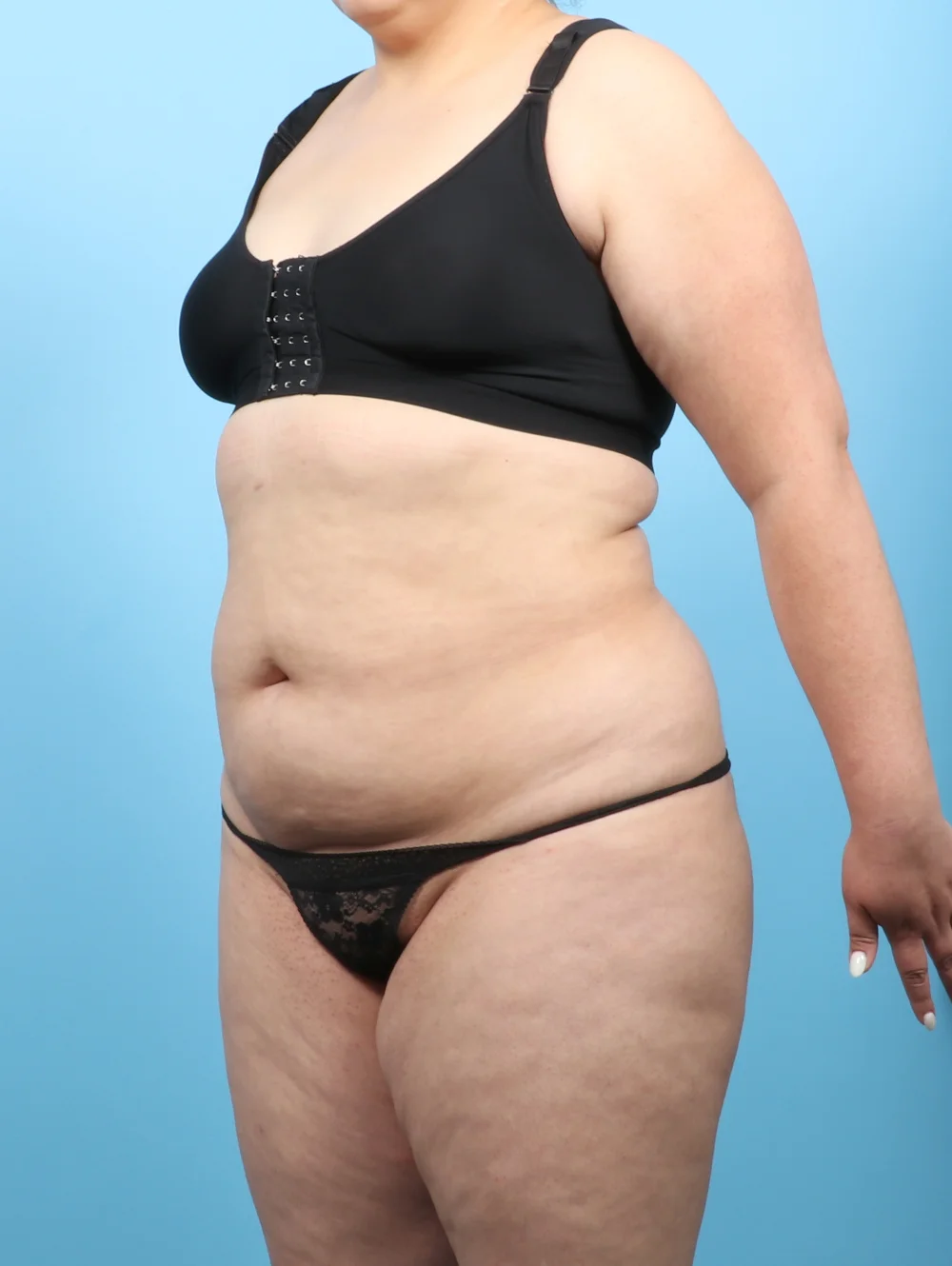 KV-LIPO-BODY-33YRS-OBL-BEFORE-edited