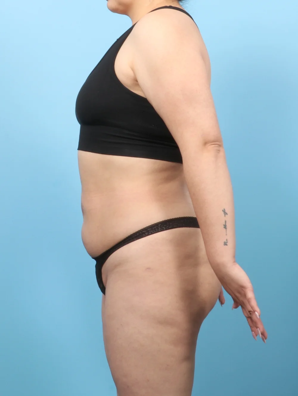 KV-LIPO-BODY-33YRS-SIDE-AFTER-edited