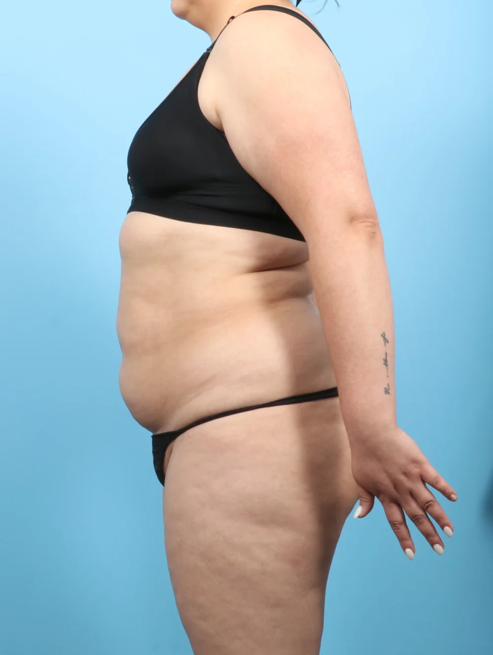 KV-LIPO-BODY-33YRS-SIDE-BEFORE-edited