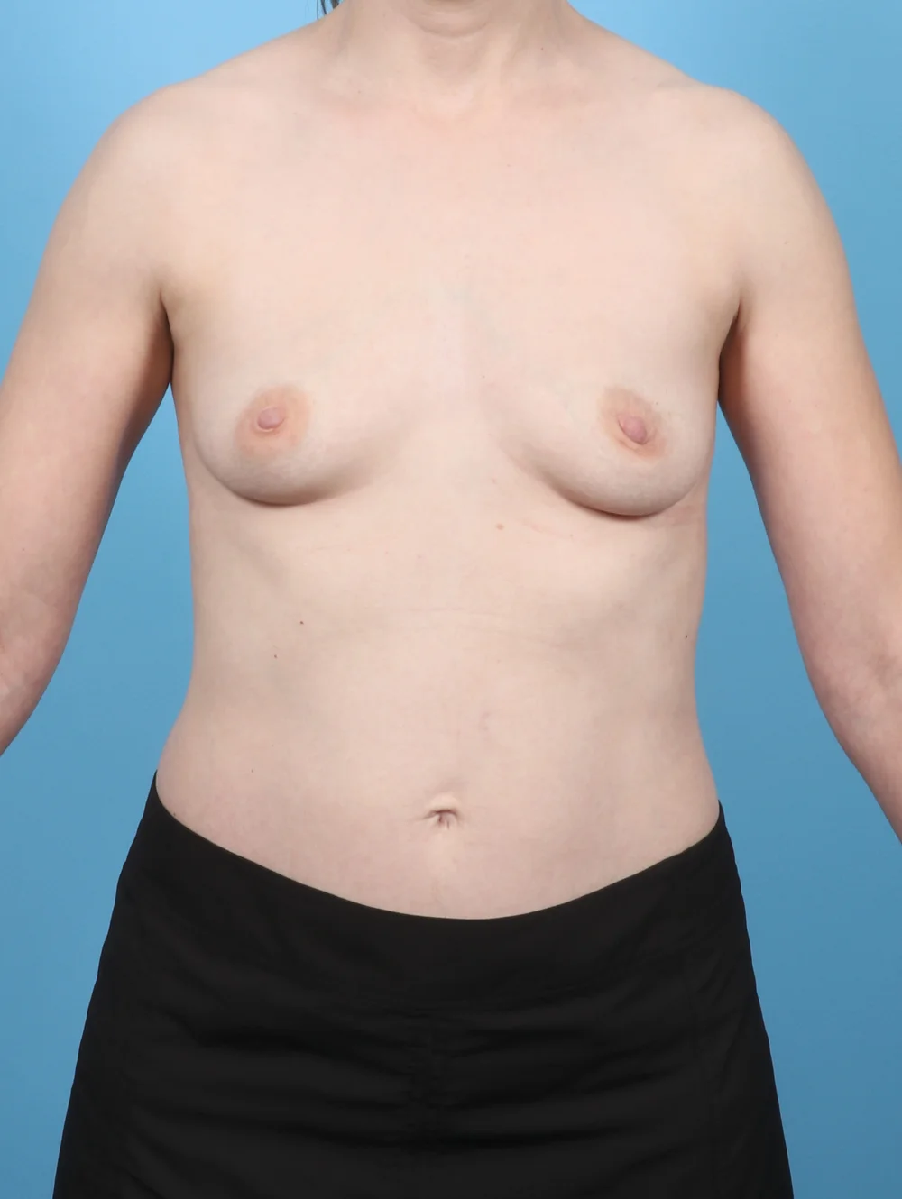 LB-BREASTAUG-43YRS-FRONT-BEFORE-edited