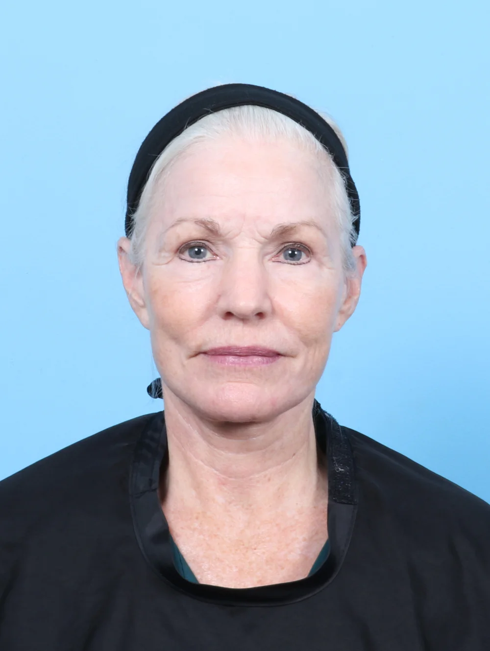 LB-FACELIFT-LASERRES-BLEPH-FRONT-AFTER-EDITED