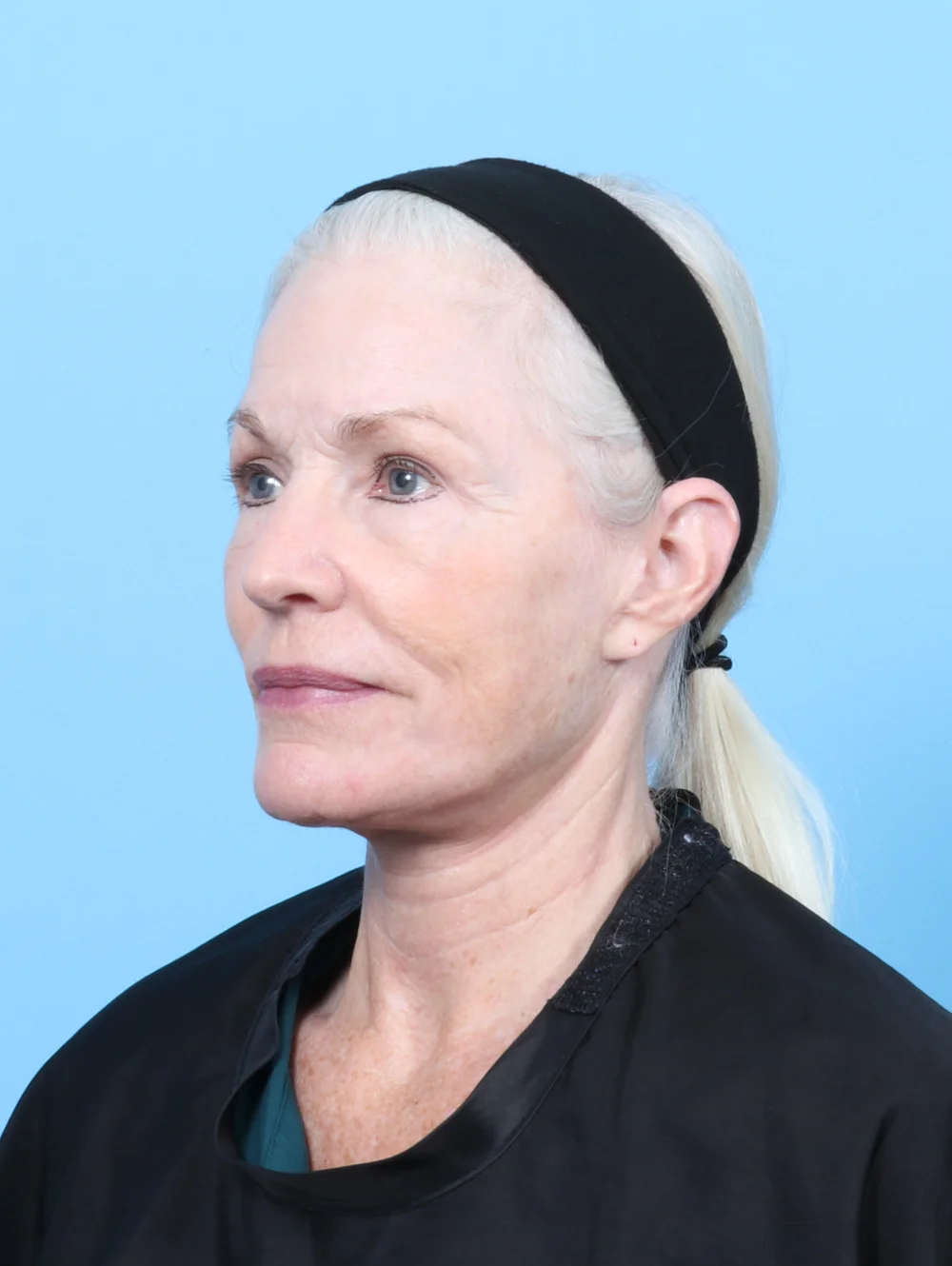 LB-FACELIFT-LASERRES-BLEPH-OBL-AFTER-EDITED