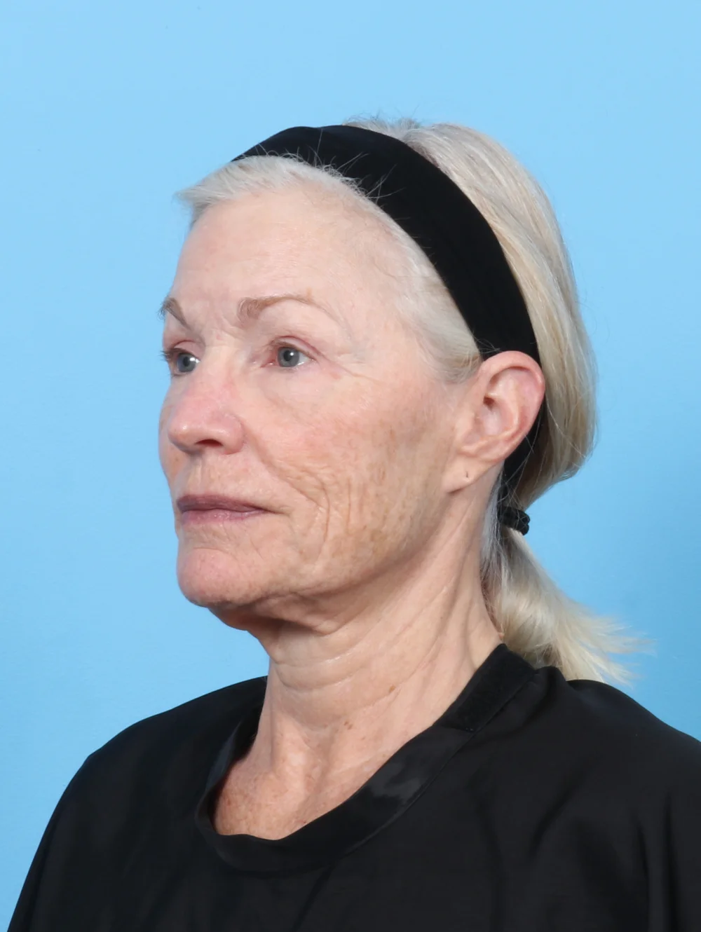 LB-FACELIFT-LASERRES-BLEPH-OBL-BEFORE-EDITED