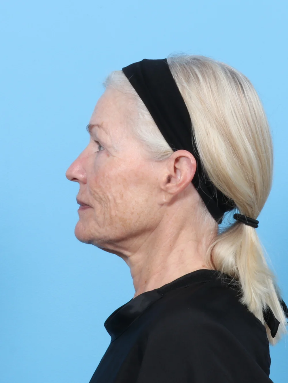 LB-FACELIFT-LASERRES-BLEPH-SIDE-BEFORE-EDITED