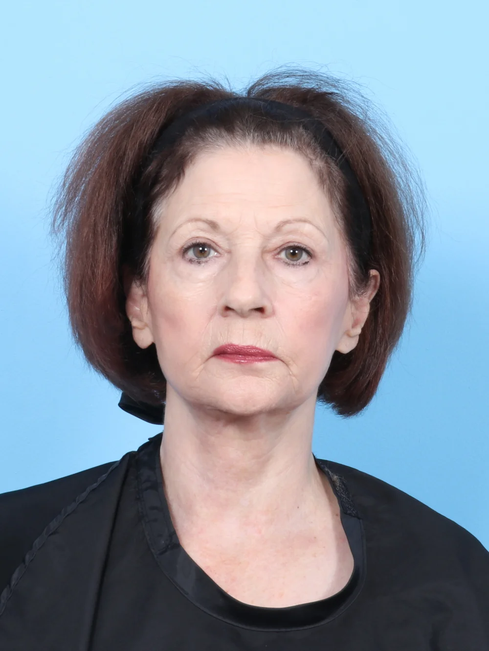 LT-FACELIFT-UBLEPH-71YRS-FRONT-AFTER-edited