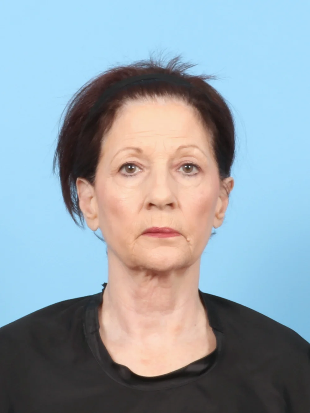 LT-FACELIFT-UBLEPH-71YRS-FRONT-BEFORE-edited