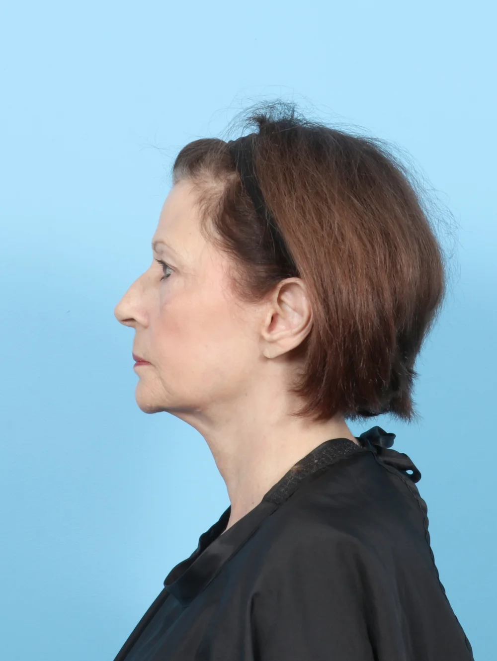 LT-FACELIFT-UBLEPH-71YRS-SIDE-AFTER-edited