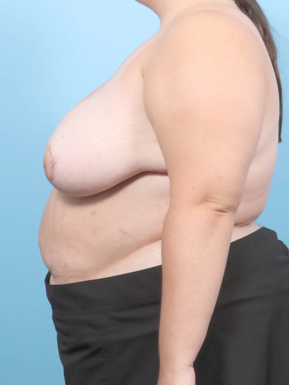 MB-REDUCTION-23YRS-SIDE-AFTER-edited