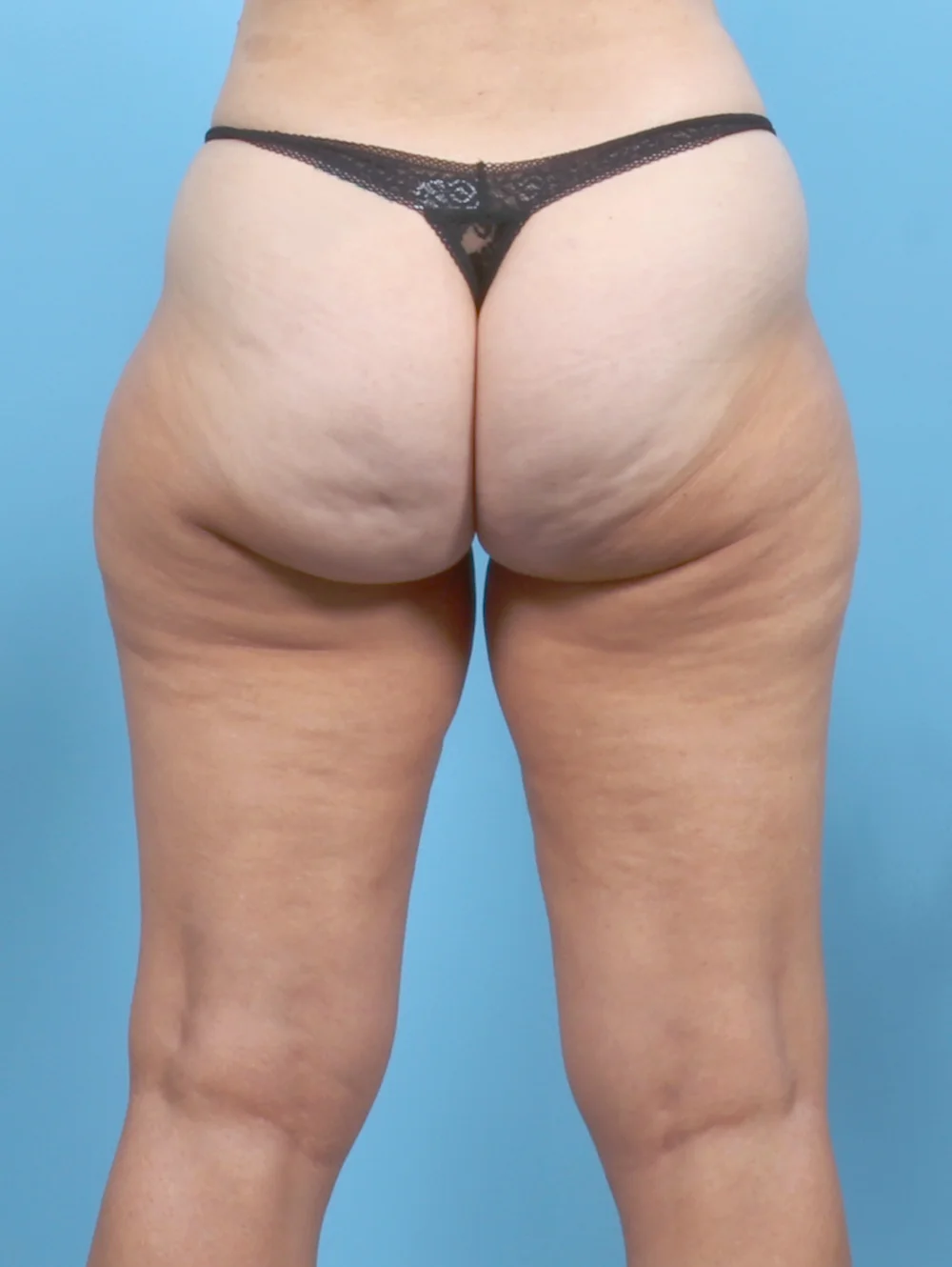 ME-THIGHLIPO-61YRS-BACK-BEFORE-EDITEDblurredtattoo