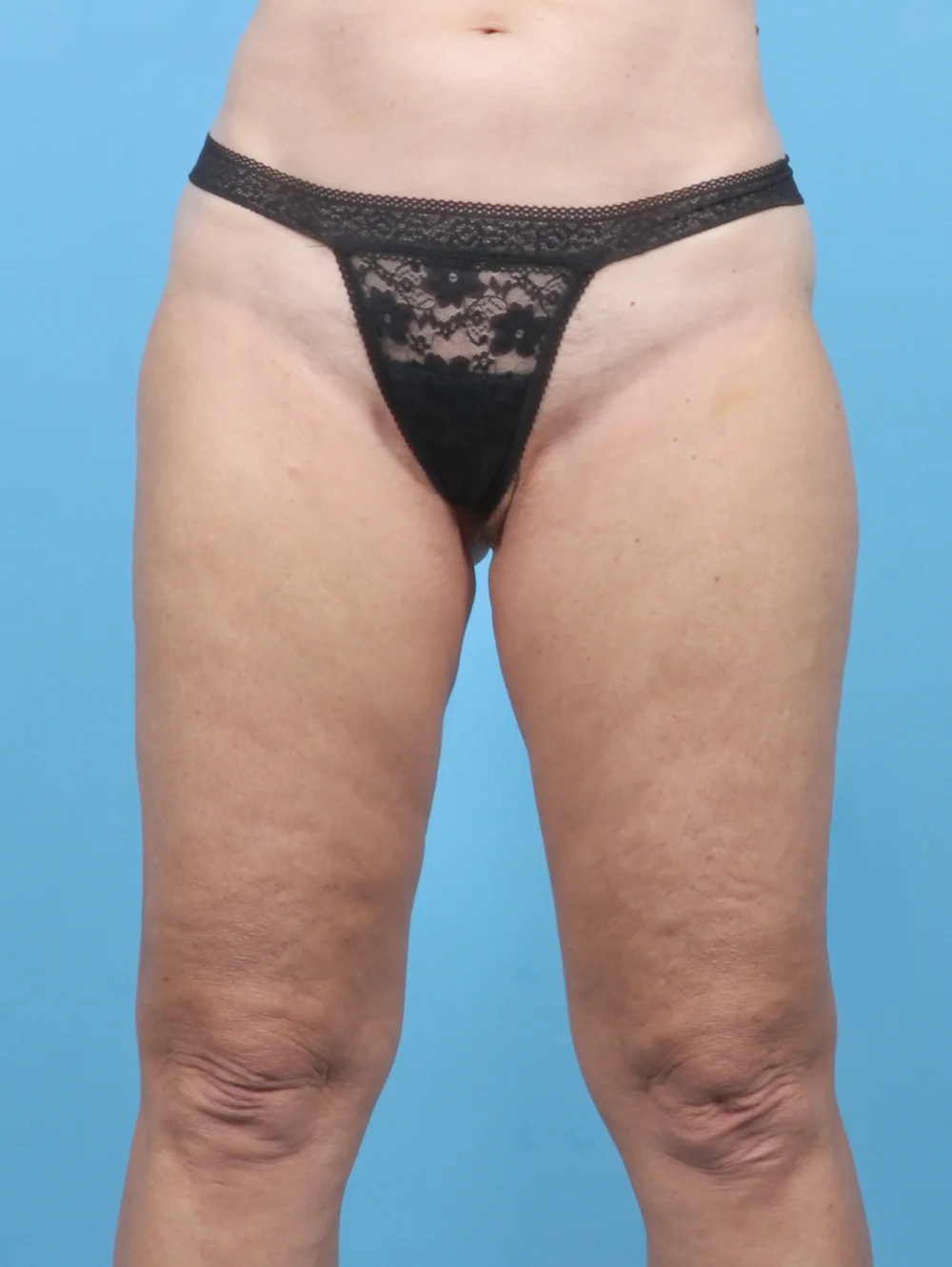 ME-THIGHLIPO-61YRS-FRONT-AFTER-EDITED