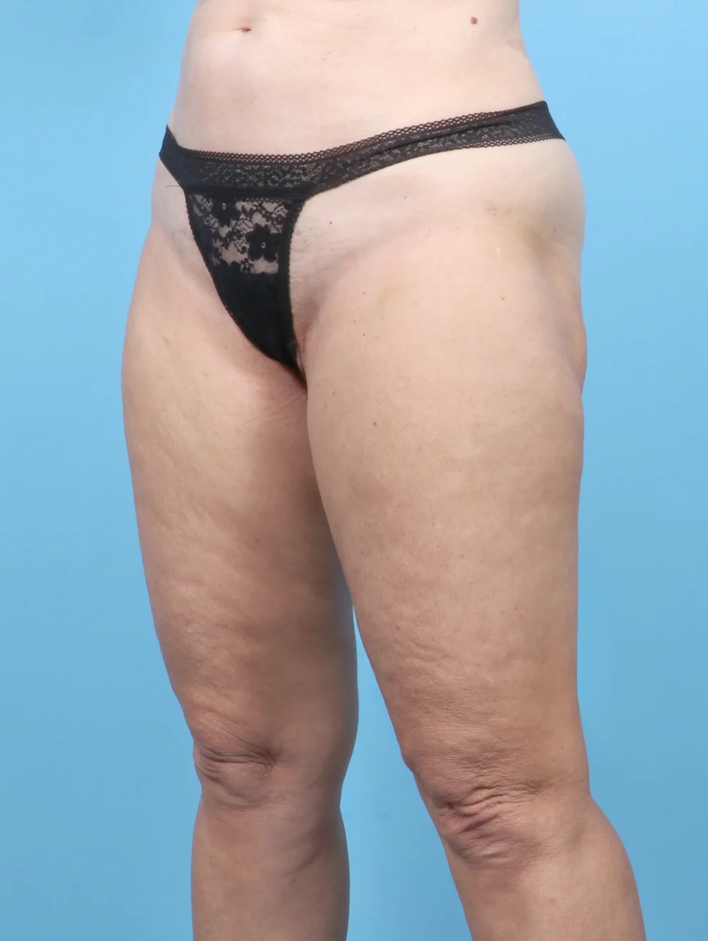ME-THIGHLIPO-61YRS-OBL-AFTER-EDITED