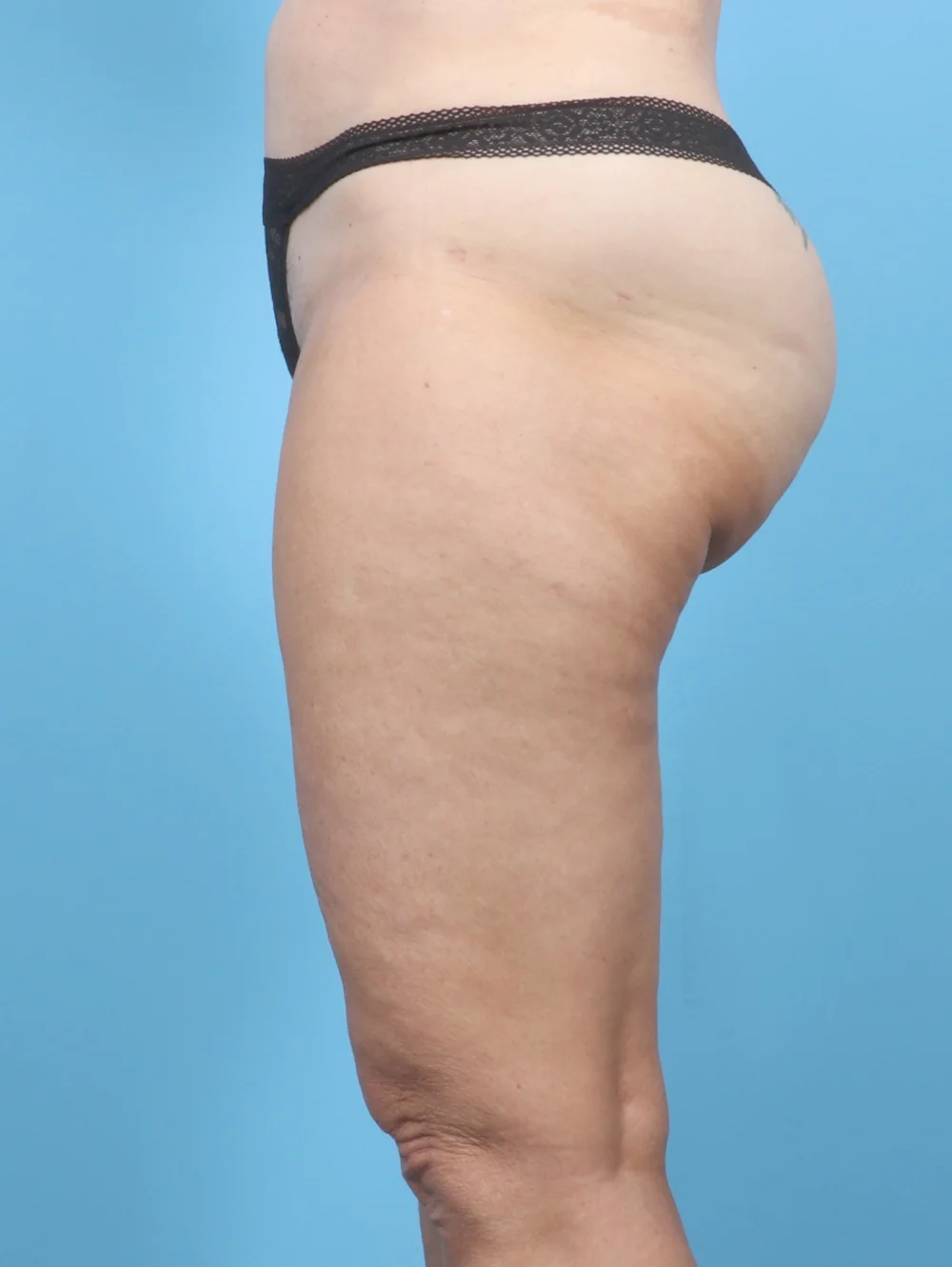 ME-THIGHLIPO-61YRS-SIDE-AFTER-EDITED