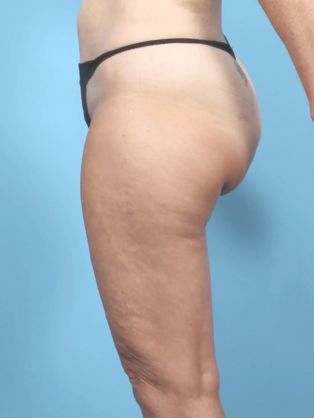 ME-THIGHLIPO-61YRS-SIDE-BEFORE-EDITED