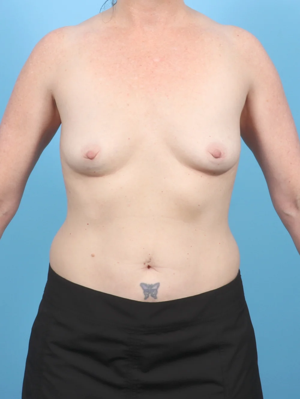 NC-BREASTAUG-48YRS-FRONT-BEFORE-EDITED