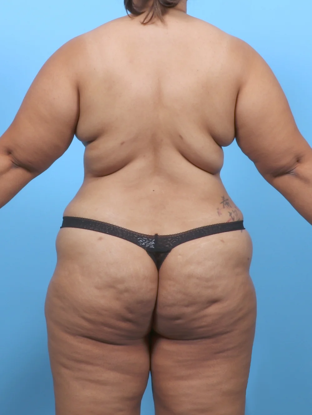 ND-TT-MASTO-LIPO-40YRS-BACK-AFTER-EDITED