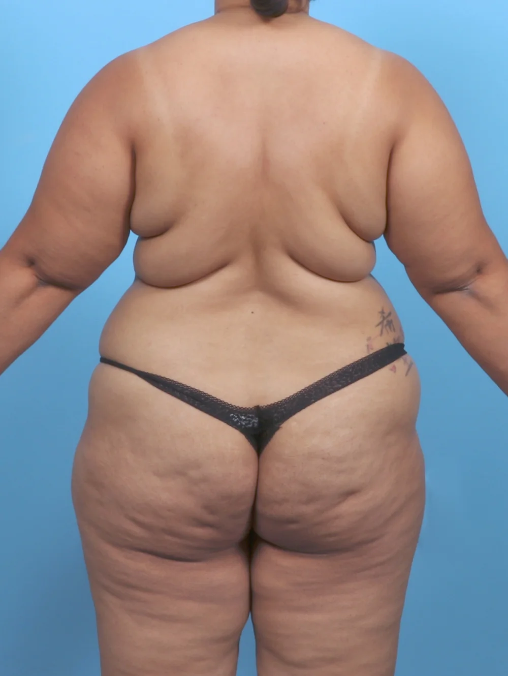 ND-TT-MASTO-LIPO-40YRS-BACK-BEFORE-EDITED