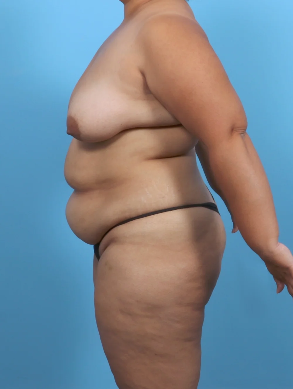 ND-TT-MASTO-LIPO-40YRS-SIDE-BEFORE-EDITED
