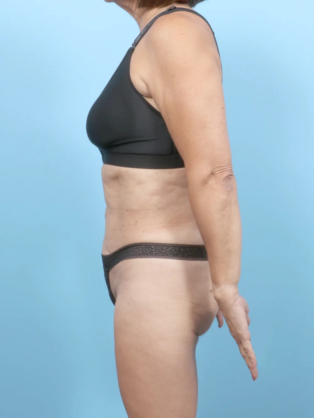 RM-LIPO-63YRS-SIDE-AFTER-edited