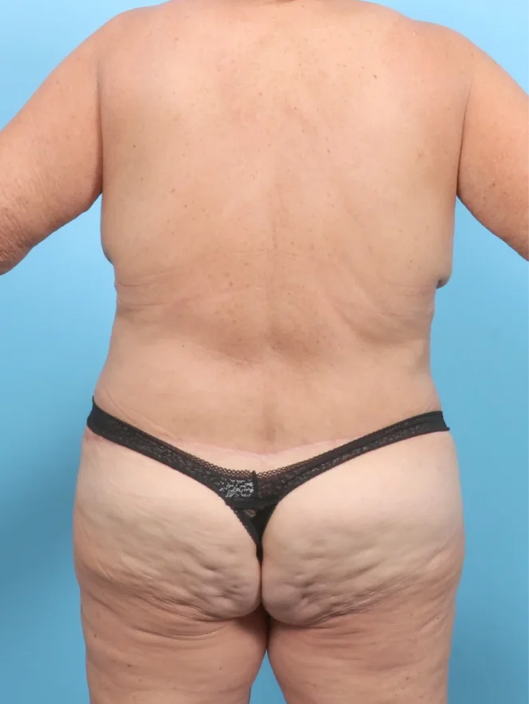 body lift after