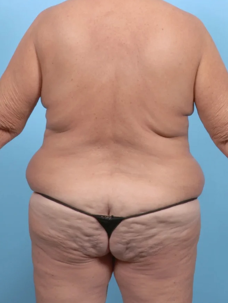 body lift before