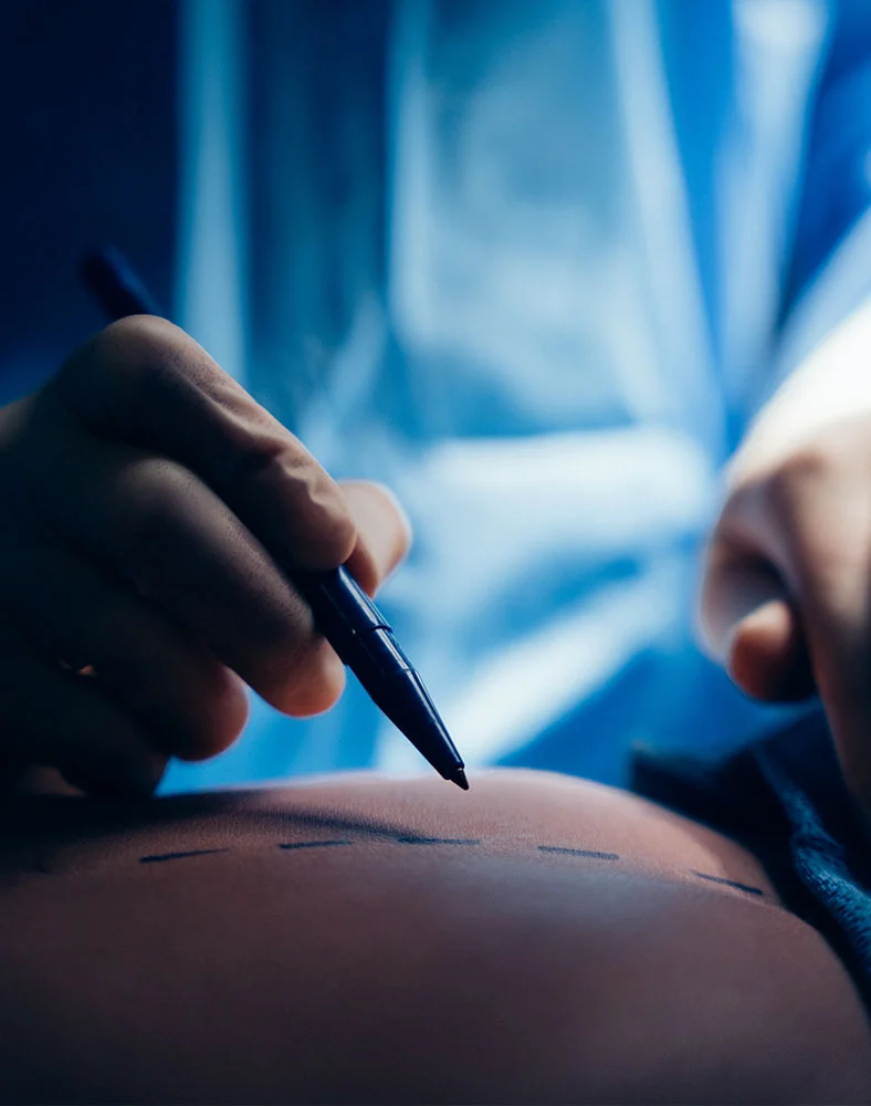 A close up shot Dr. Daly marking a patients stomach while prepping for surgery. - Tummy Tuck in Folsom, CA