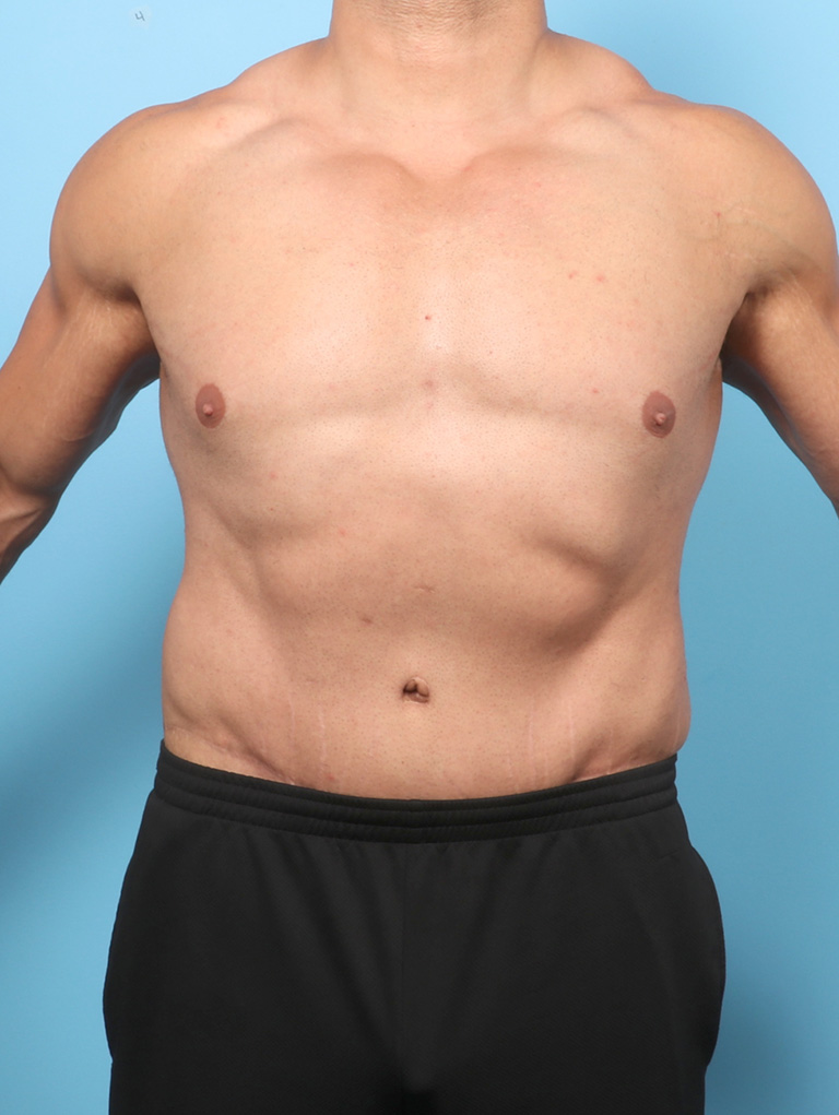 AA-BODYLIFT-44YRS-FRONT-AFTER-edited