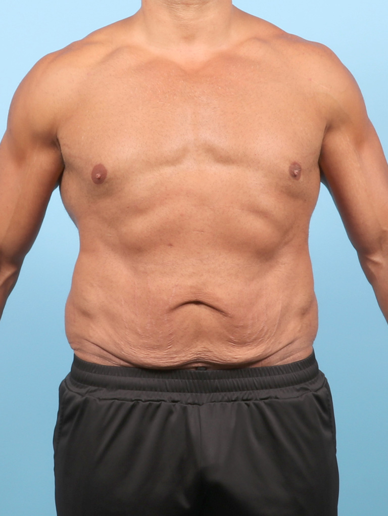 AA-BODYLIFT-44YRS-FRONT-BEFORE-edited