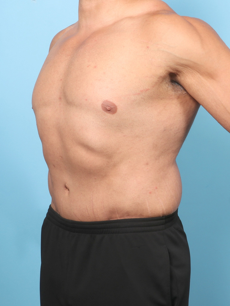 AA-BODYLIFT-44YRS-OBL-AFTER-edited