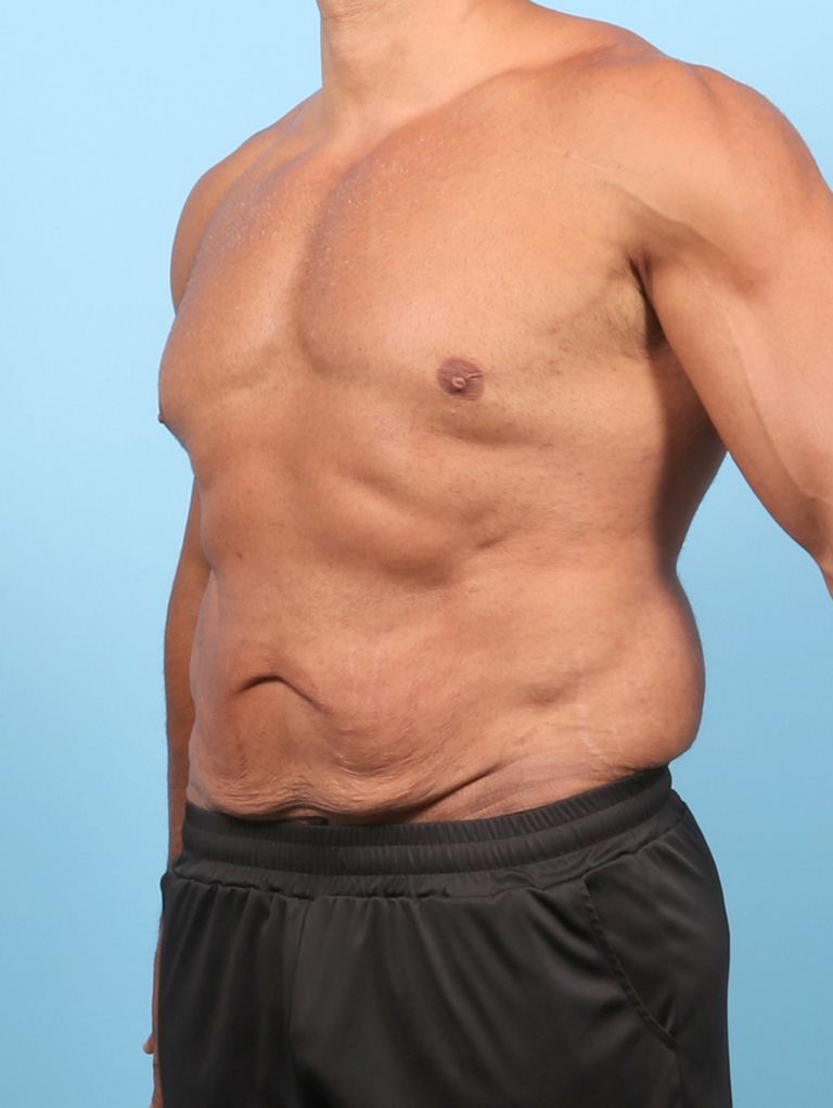 AA-BODYLIFT-44YRS-OBL-BEFORE-edited