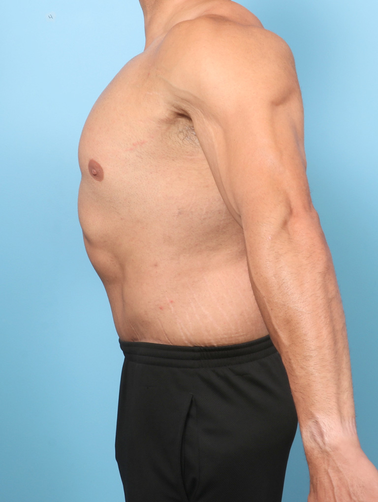 AA-BODYLIFT-44YRS-SIDE-AFTER-edited