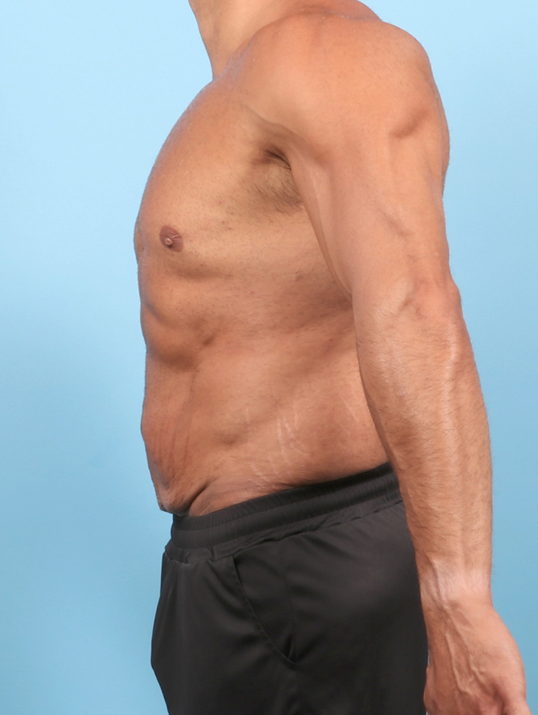 AA-BODYLIFT-44YRS-SIDE-BEFORE-edited