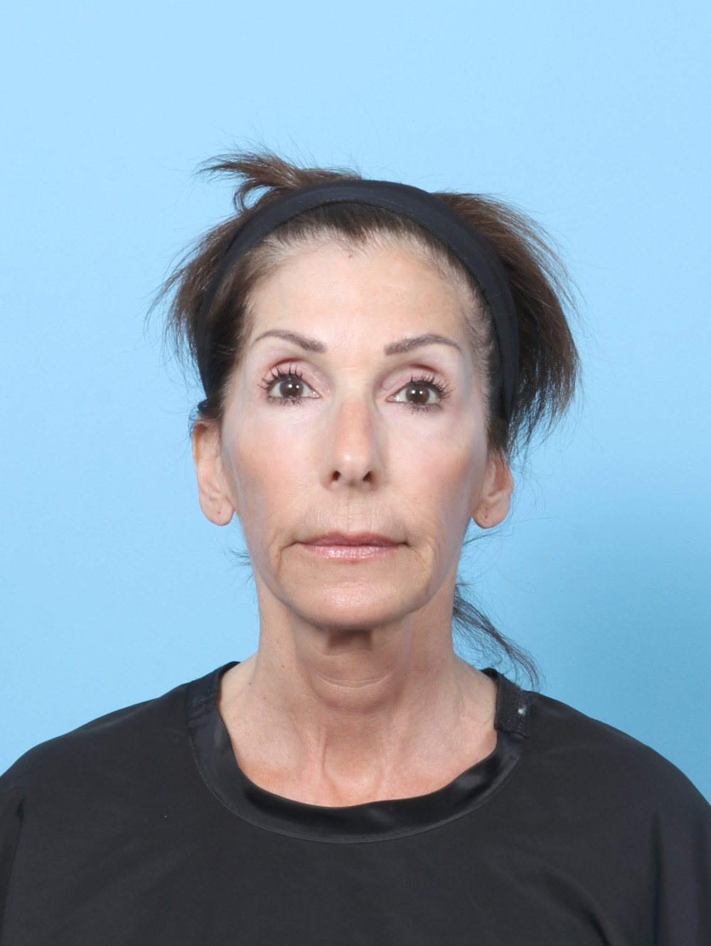 JS-63YRS-LBLEPH-FATTRANS-LASER-FRONT-AFTER-edited