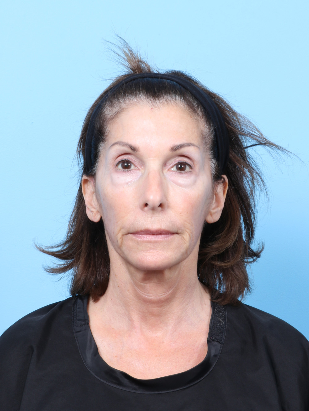JS-63YRS-LBLEPH-FATTRANS-LASER-FRONT-BEFORE-edited