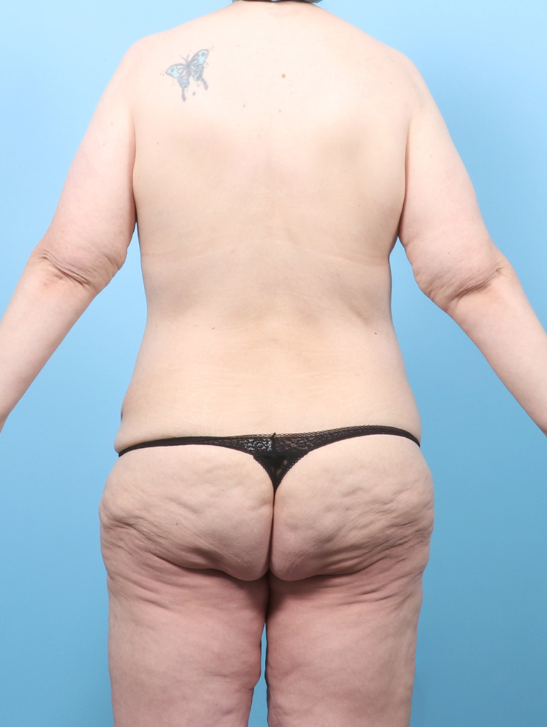 VC-BODYLIFT-BRACHIO-47YRS-BACK-BEFORE-EDITED