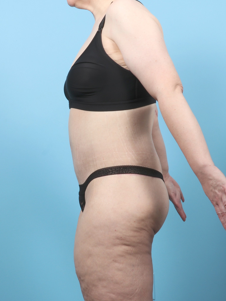 VC-BODYLIFT-BRACHIO-47YRS-SIDE-AFTER-EDITED