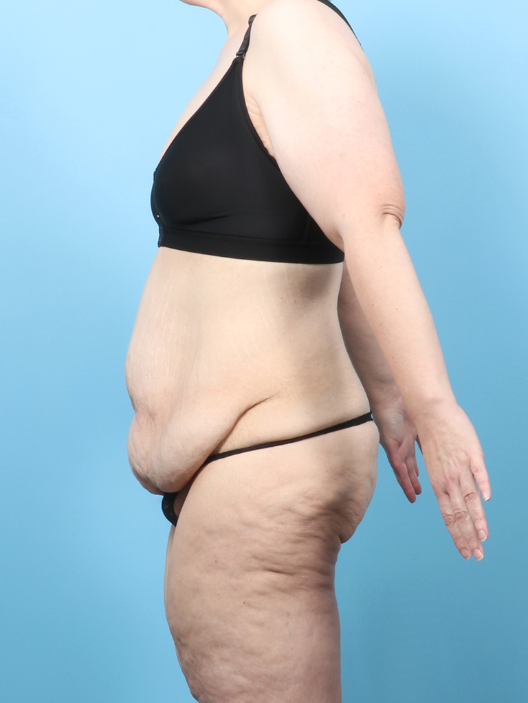 VC-BODYLIFT-BRACHIO-47YRS-SIDE-BEFORE-EDITED